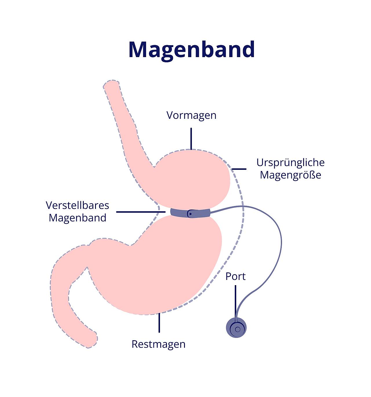 Die Graphik zeigt einen Magen mit Magenband. Das Magenband teilt den Magen in kleinen Vormagen und großen Restmagen auf.