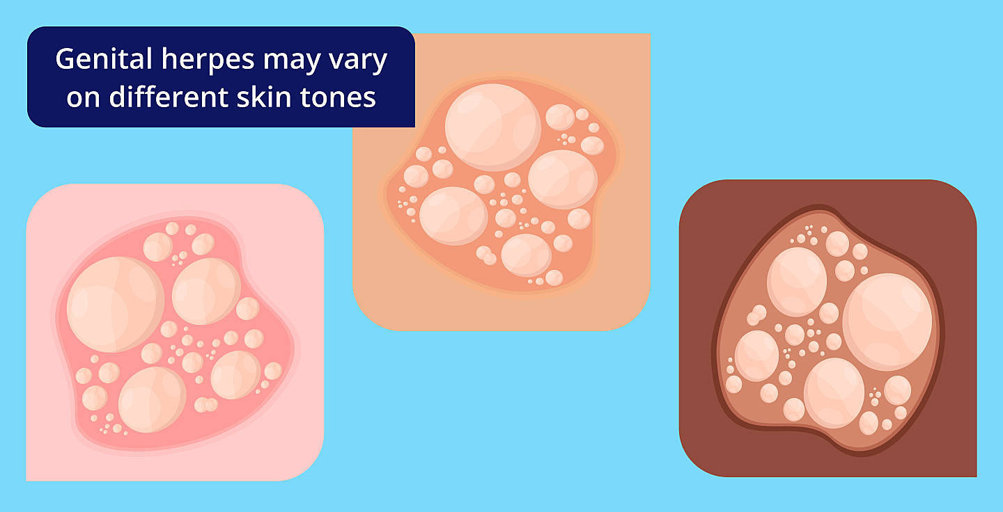 how genital herpes may look on different skin tones