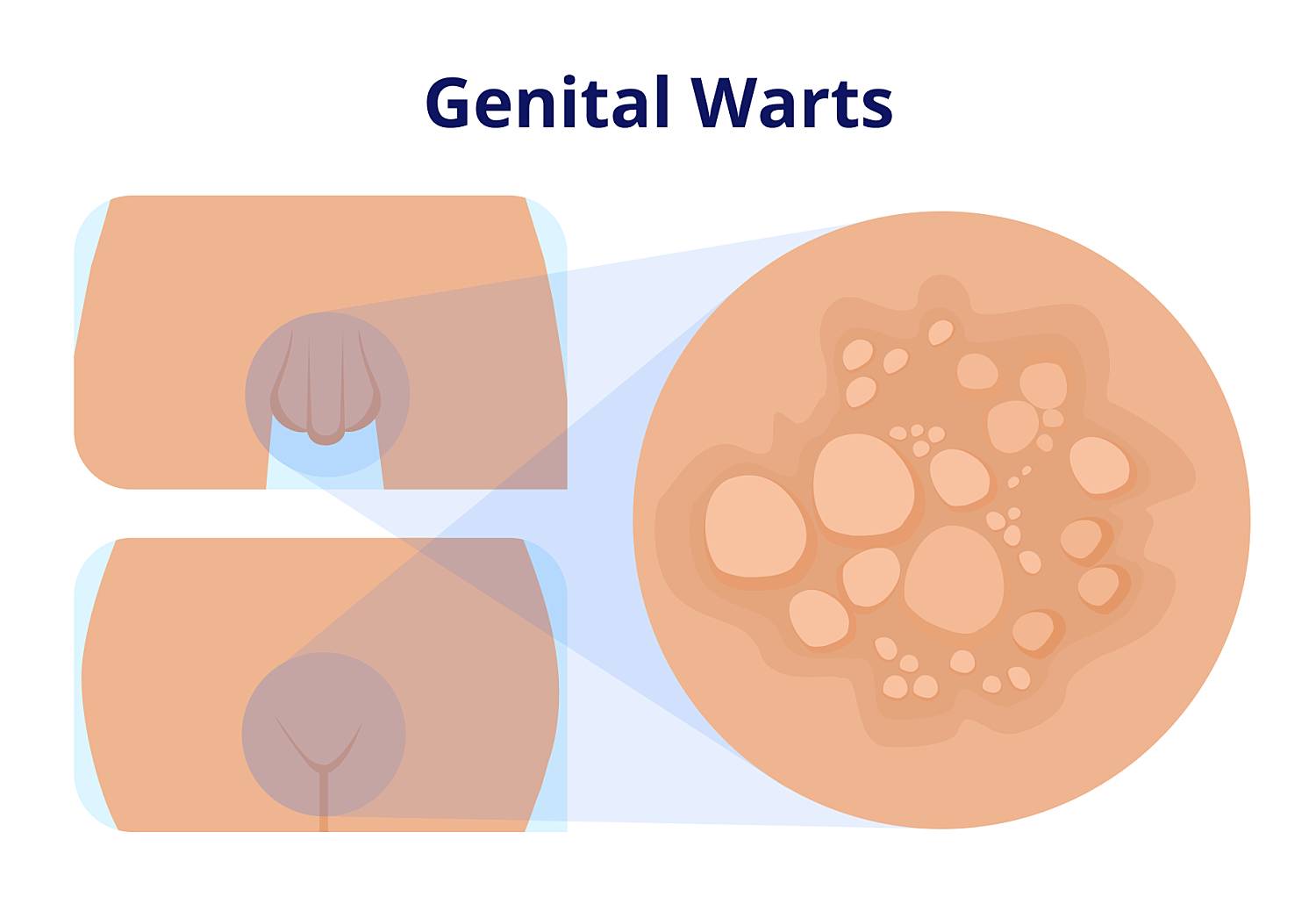 genital warts example