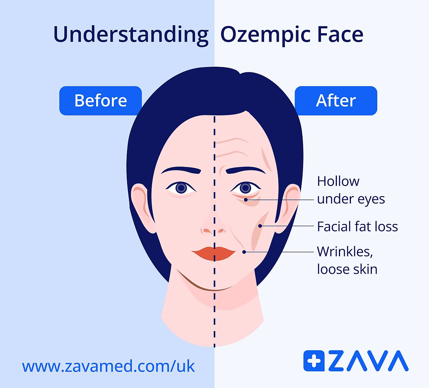 how Ozempic face looks like