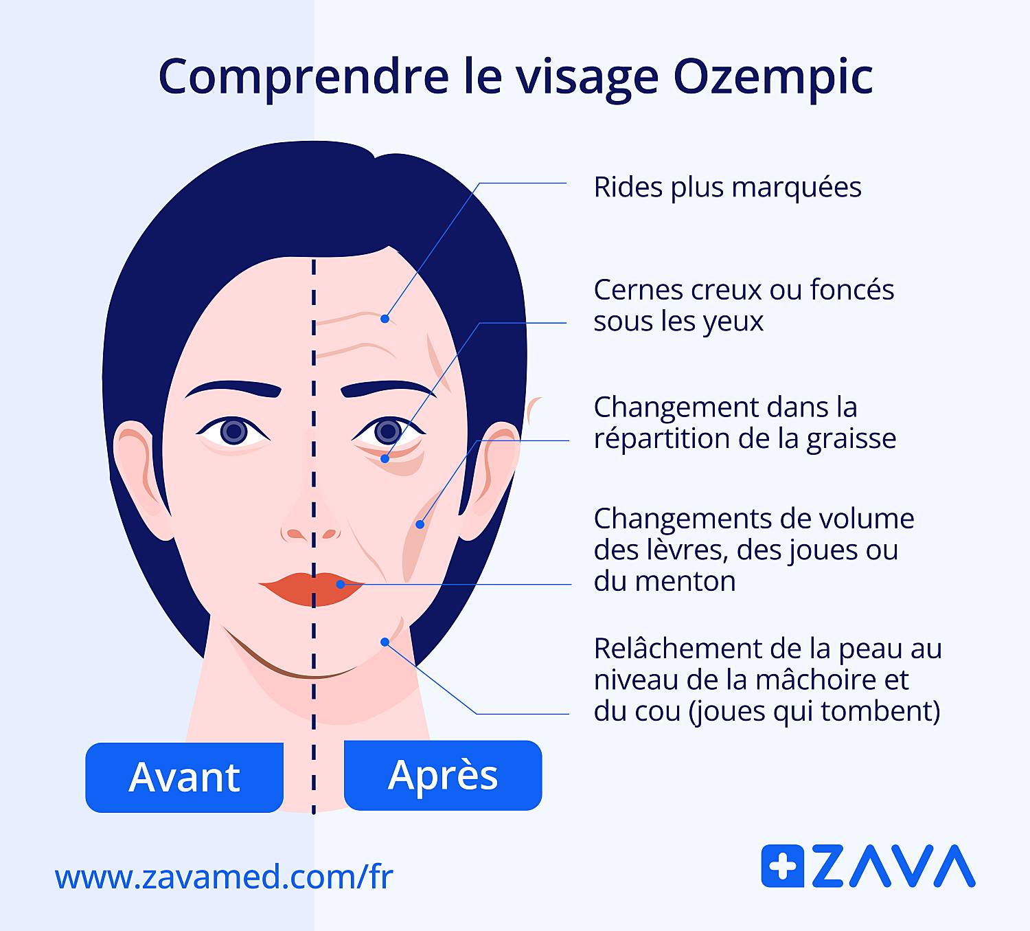 Infographie montrant les changements faciaux possibles après une perte de poids rapide, comme des rides plus marquées, des cernes creux et un relâchement de la peau.