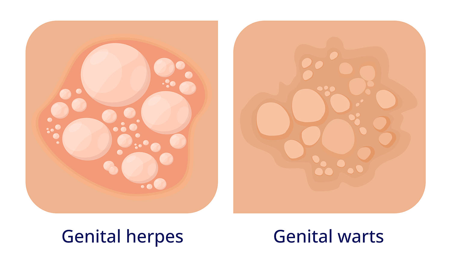 genital herpes vs genital warts example on skin