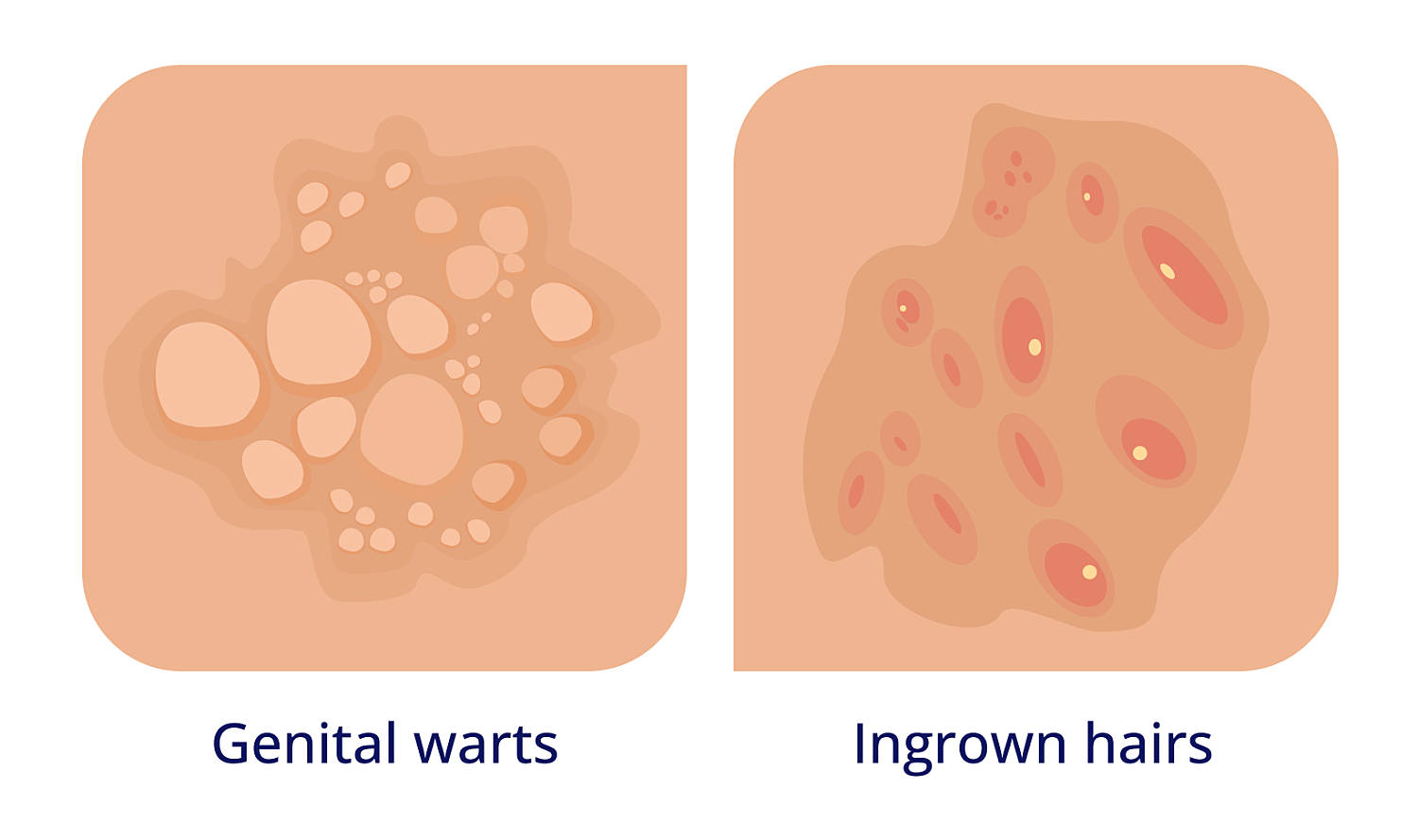 ingrown hairs vs genital warts example on skin