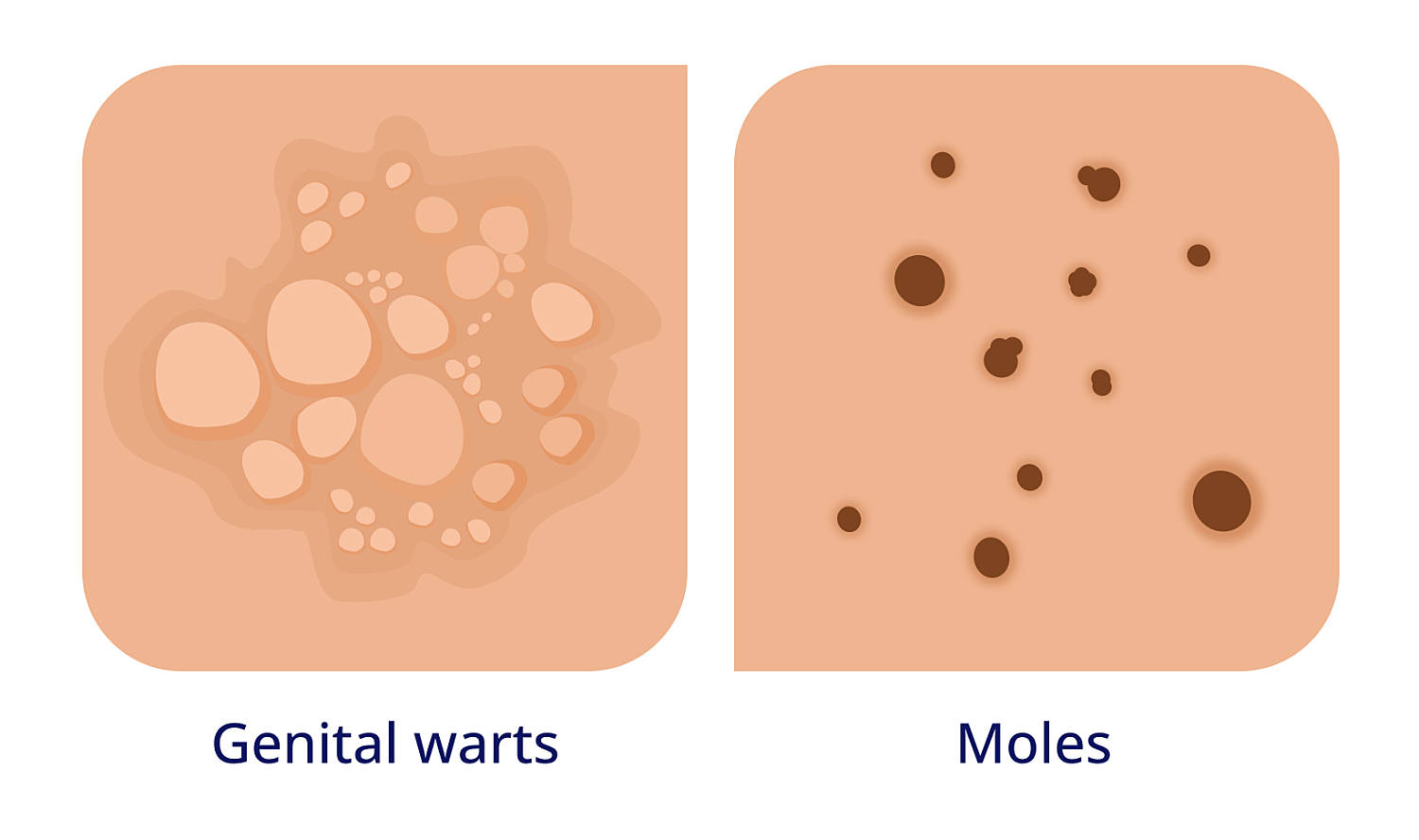 genital warts vs moles example on skin