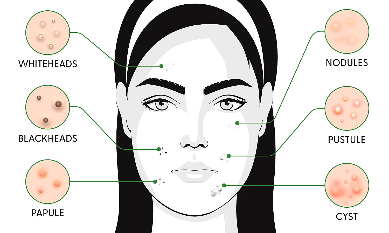 Different Types of Acne: 6 Types & How To Treat Them | Superdrug Online ...