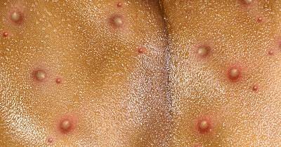 A close-up photo of a monkeypox rash on someone's back