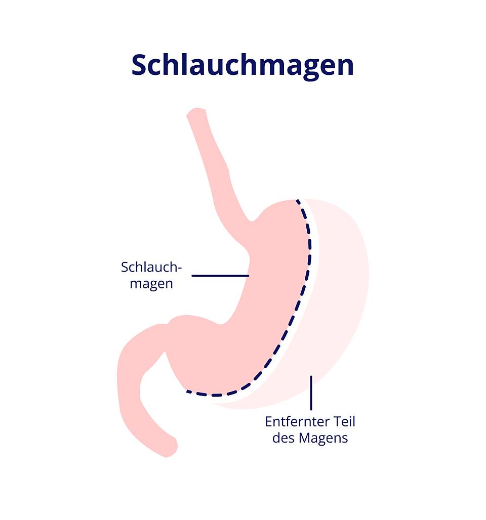 Eine beispielhafte Darstellung eines Schlauchmagens