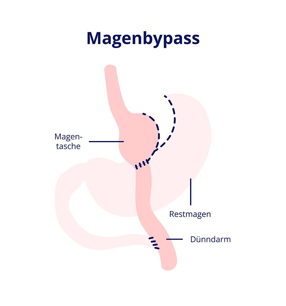 Darstellung des Aufbaus von einem Magenbypass