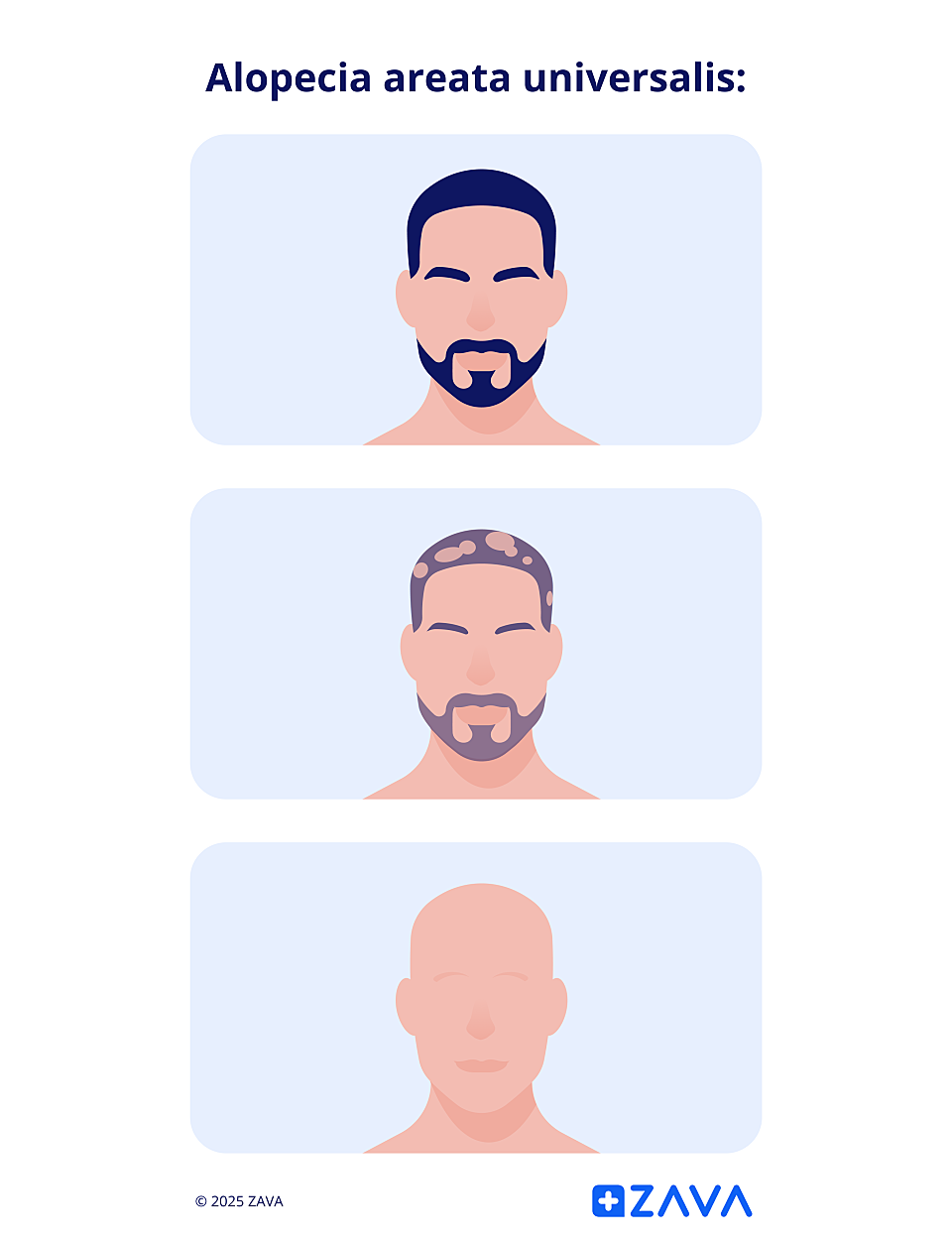 Die Haare fallen am ganzen Körper aus, also auch die Augenbrauen, Wimpern und der Bart.
