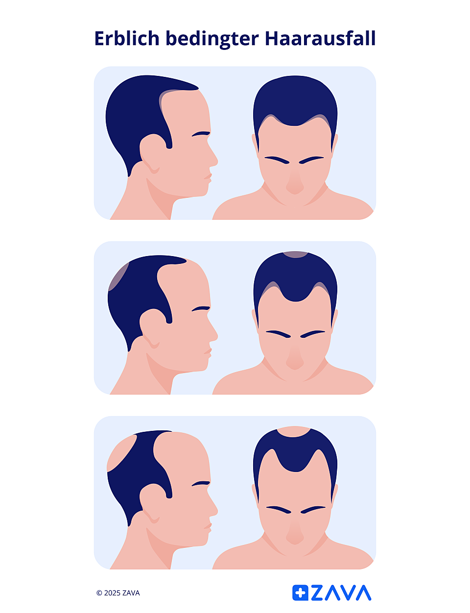 Die Grafik zeigt die Entwicklung von erblich bedingtem Haarausfall.