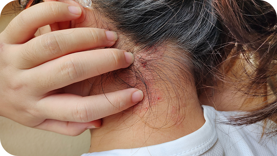 eczema du cuir chevelu