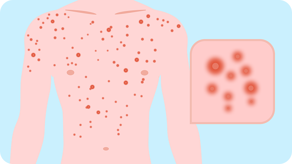 illustration showing initial hiv rash