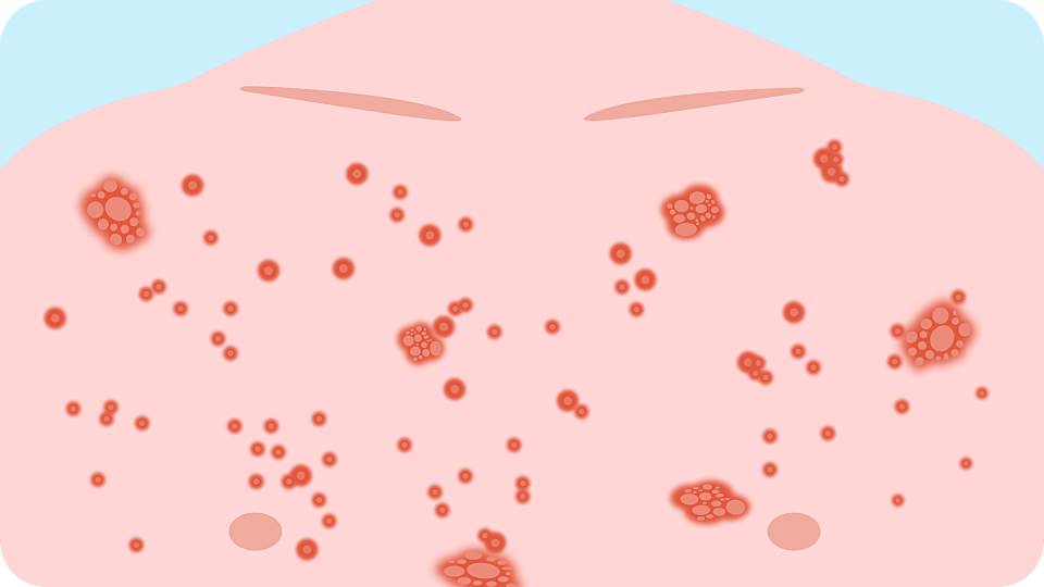 illustration showing hiv medication rash