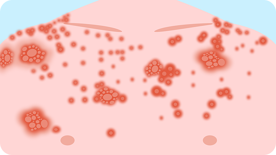 illustration showing advanced hiv rash