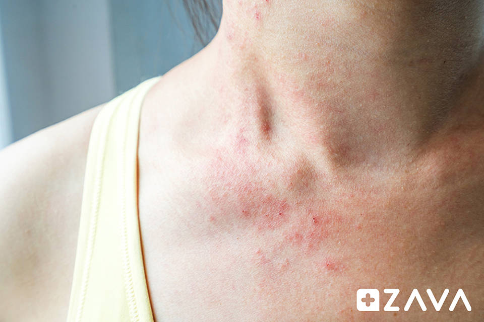rash