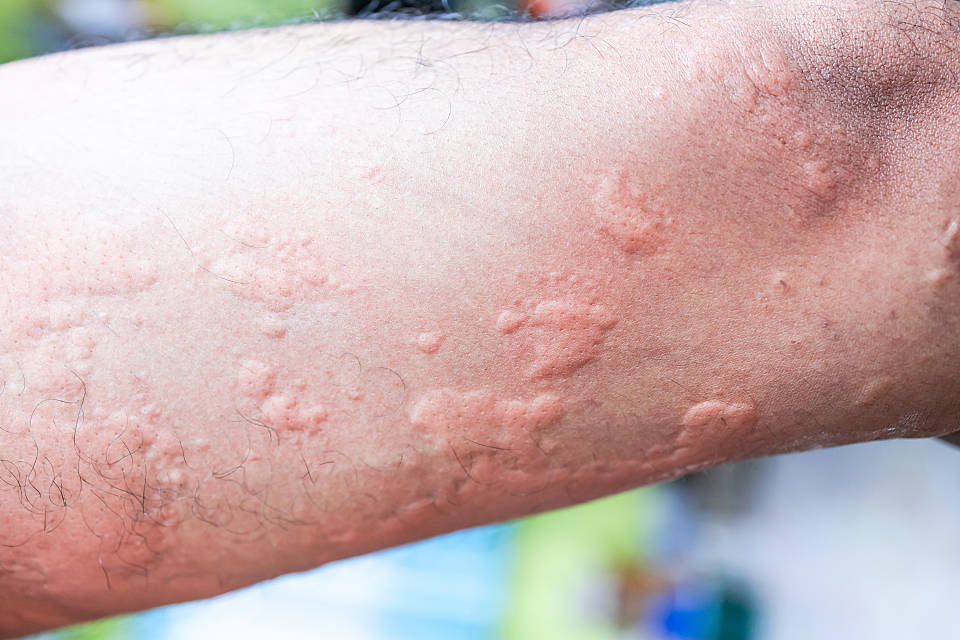 kleine Bläschen auf der Haut durch eine Kontaktallergie