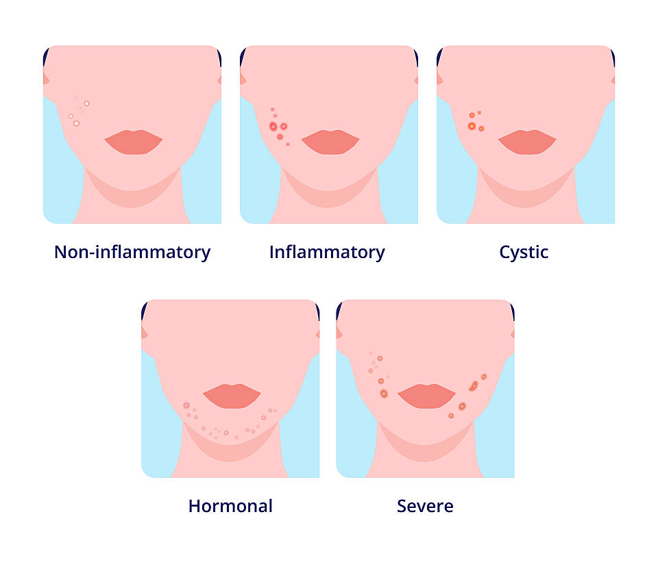 what different types of acne can look like