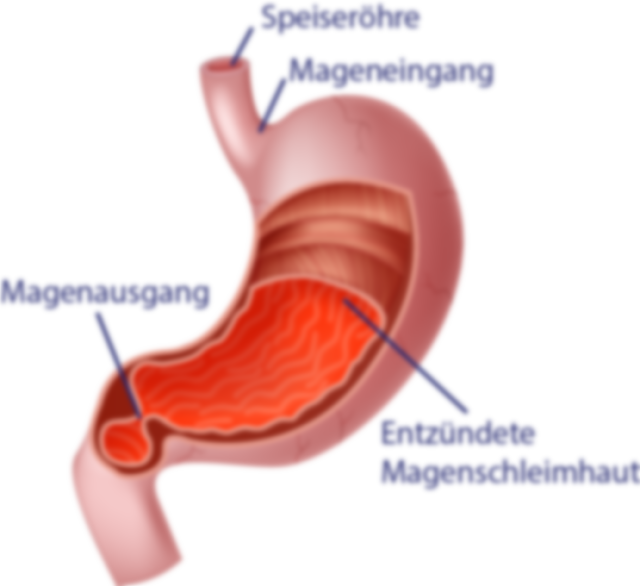 Illustrierte Abbildung eines Magens mit entzündeter Magenschleimhaut