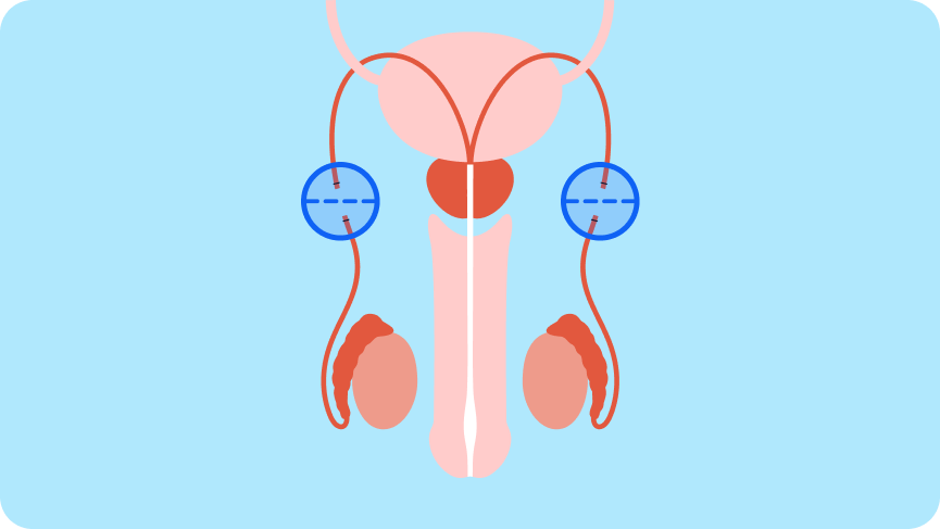 Vasectomie