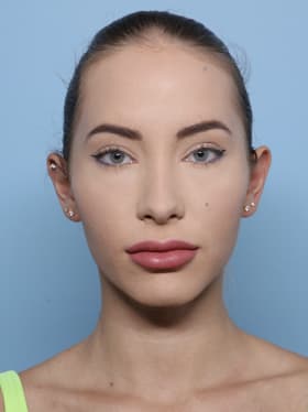 Brow Lift before - front view