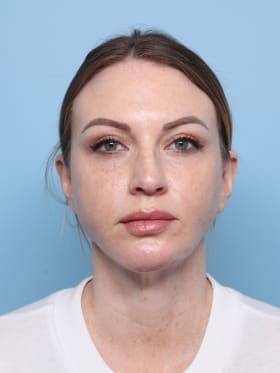 Blepharoplasty after - front view