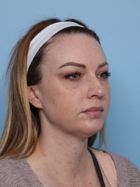 Blepharoplasty before - oblique right