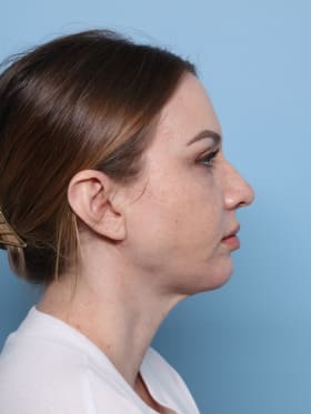 Blepharoplasty after - side right