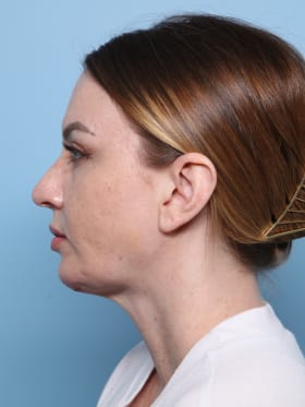 Blepharoplasty after - side left