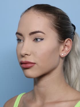Brow Lift before - oblique left