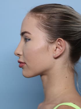 Brow Lift before - side left