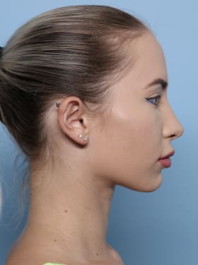 Brow Lift before - side right