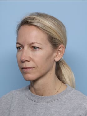 Brow Lift before - oblique left