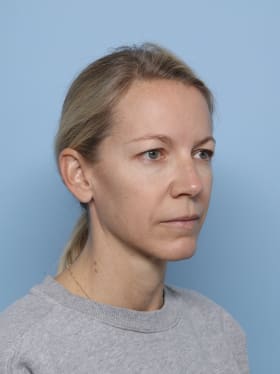 Brow Lift before - oblique right