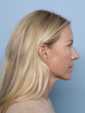 Brow Lift after - side right