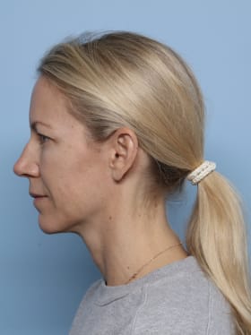 Brow Lift before - side left