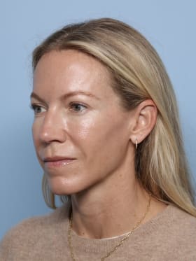Brow Lift after - oblique left