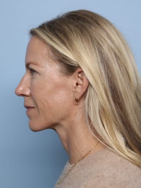 Brow Lift after - side left