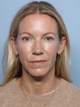 Brow Lift after - front view