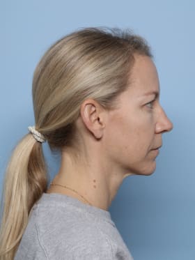Brow Lift before - side right