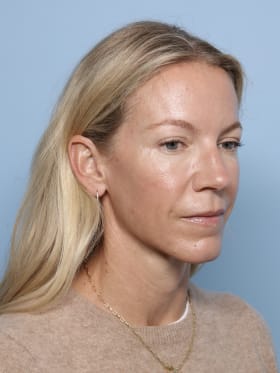 Brow Lift after - oblique right