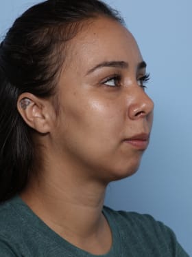 Buccal Fat Removal after - oblique right