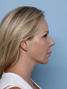 Buccal Fat Removal after - side right