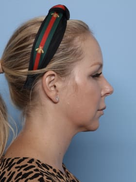 Buccal Fat Removal before - side right