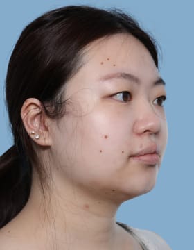 Buccal Fat Removal before - oblique right