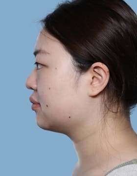 Buccal Fat Removal before - side left