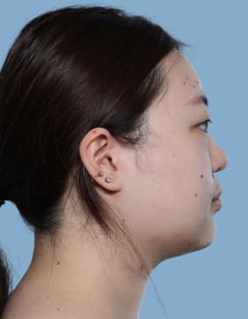 Buccal Fat Removal before - side right