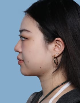 Buccal Fat Removal after - side left