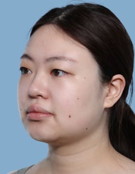 Buccal Fat Removal before - oblique left