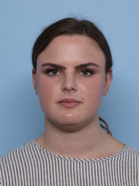 Buccal Fat Removal before - front view