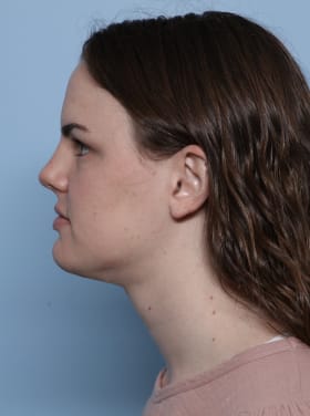 Buccal Fat Removal after - side left